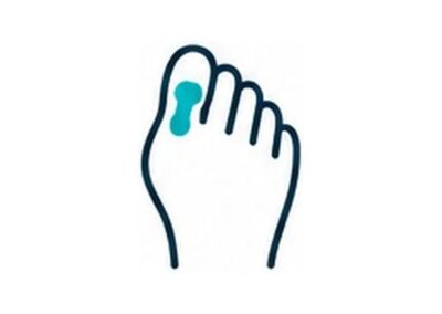 ALLUX VALGUS